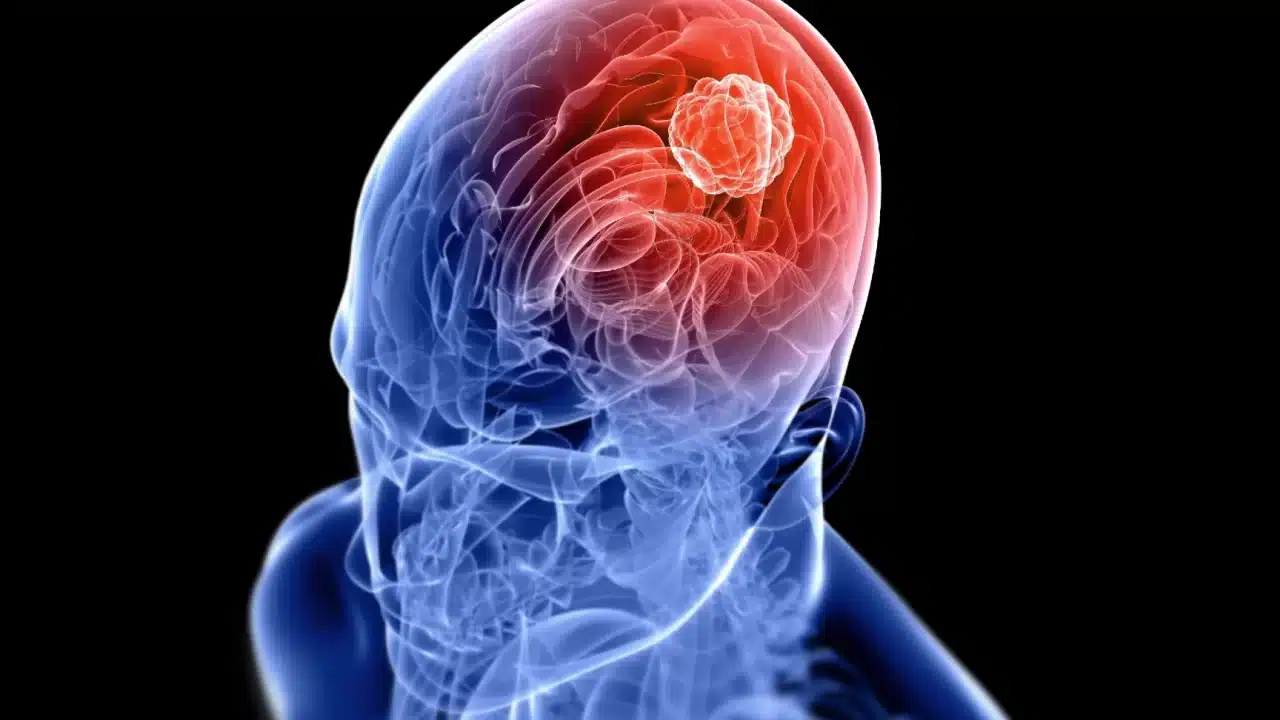 tumor cabeza