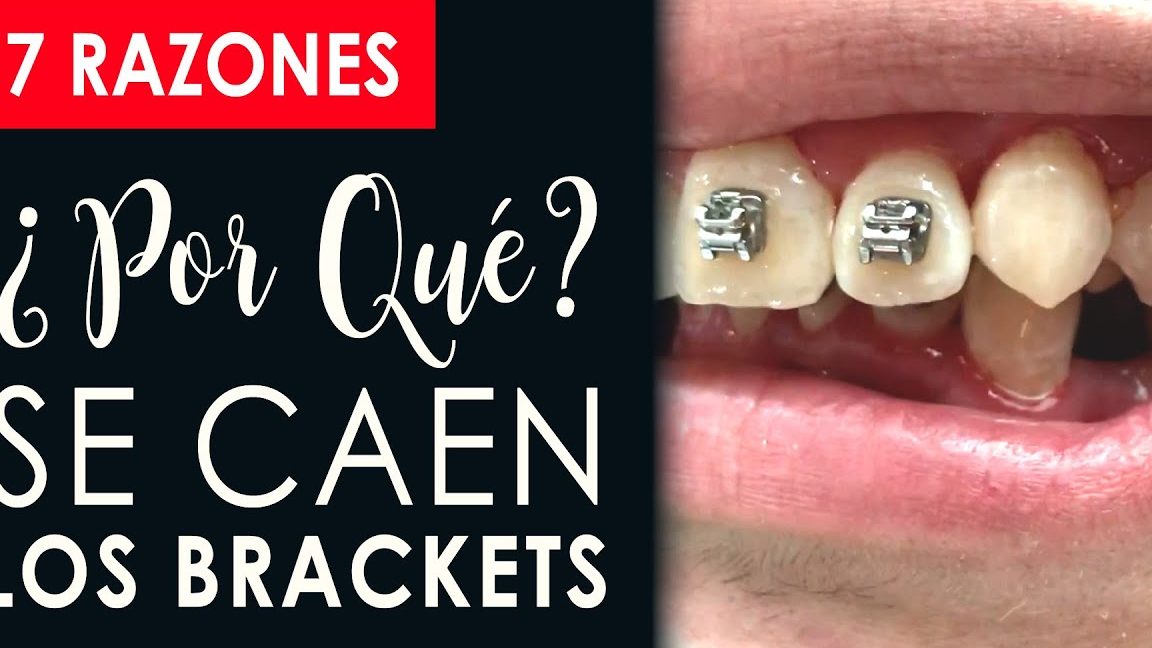 caen brackets 1