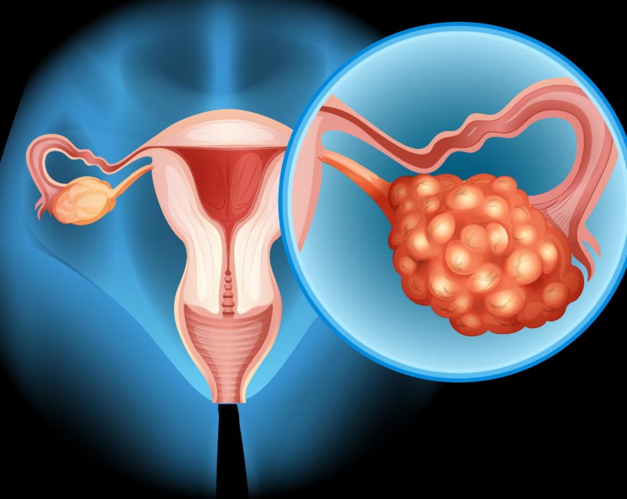 cancer ovarios