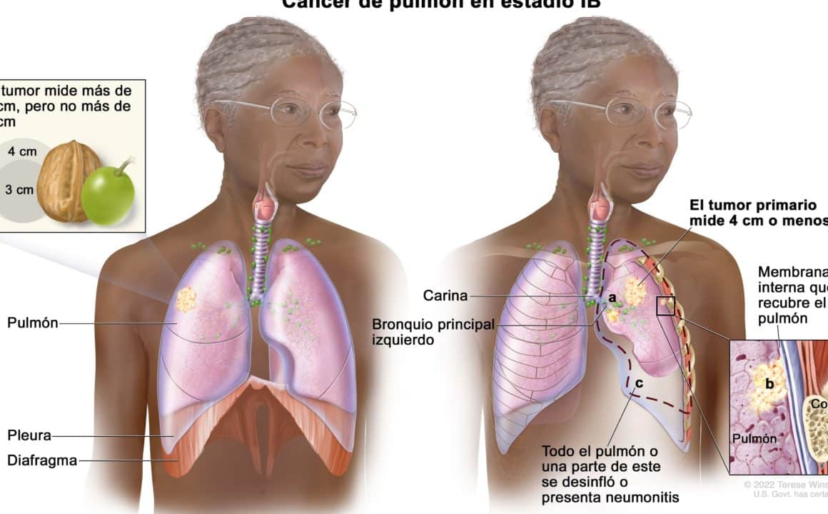 cancer pulmon 1