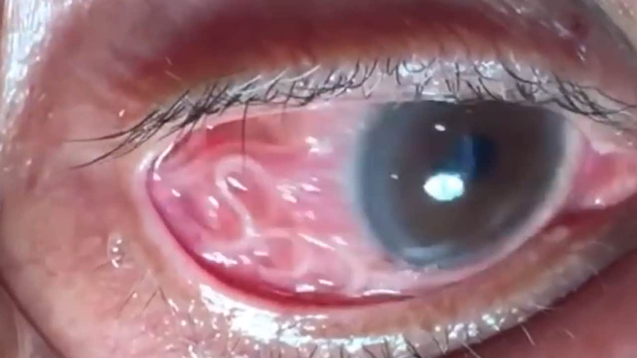 gusano ojo 1