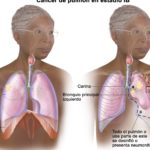 cancer pulmon 1