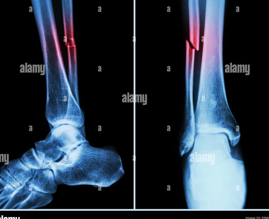 fractura pierna