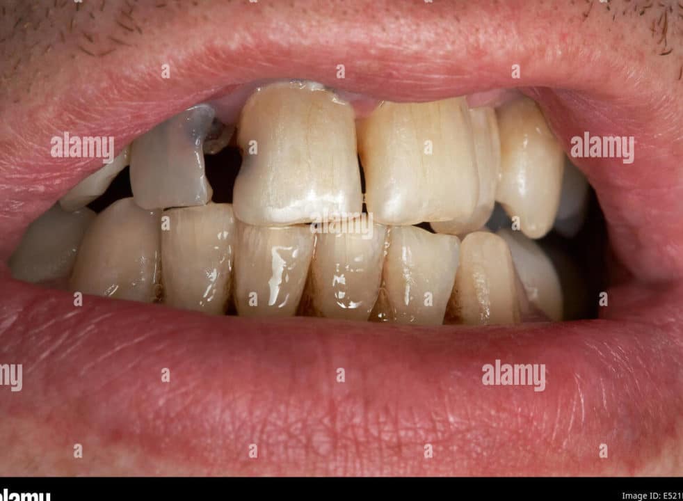 pudren dientes
