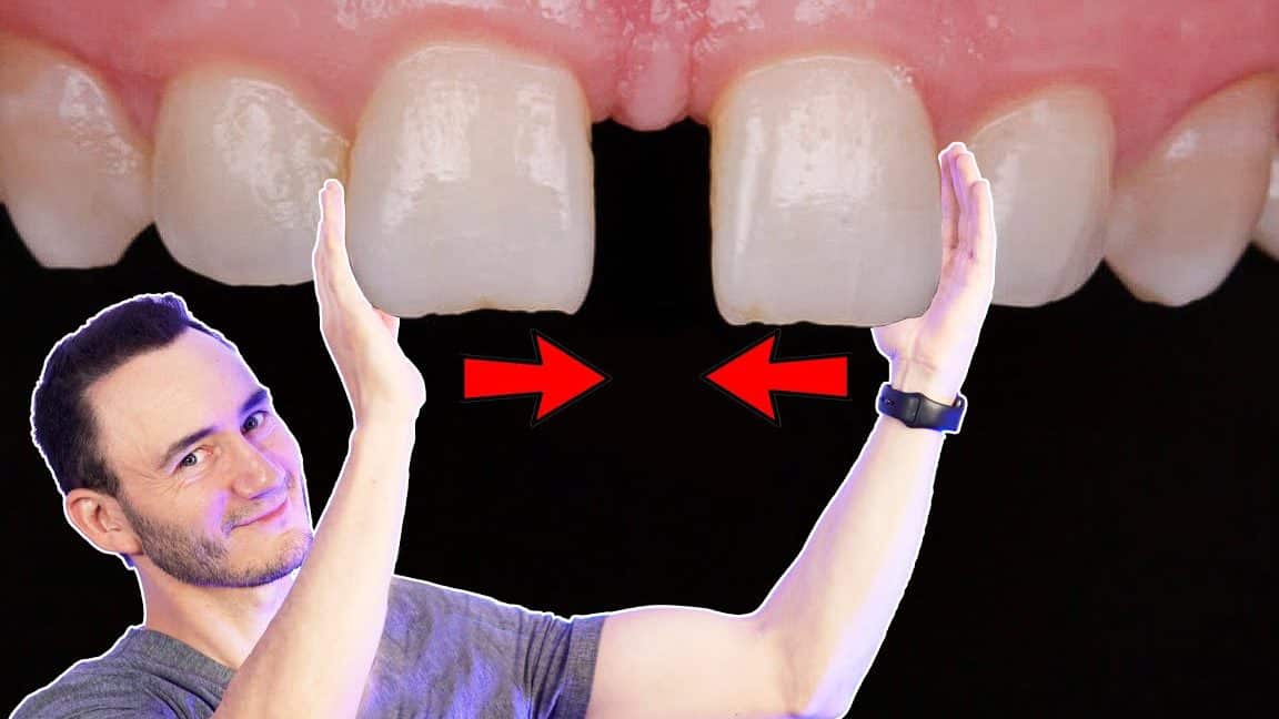 separan dientes