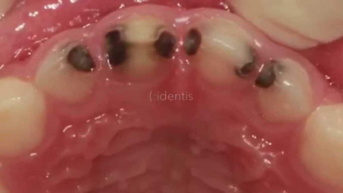 dientes cariados